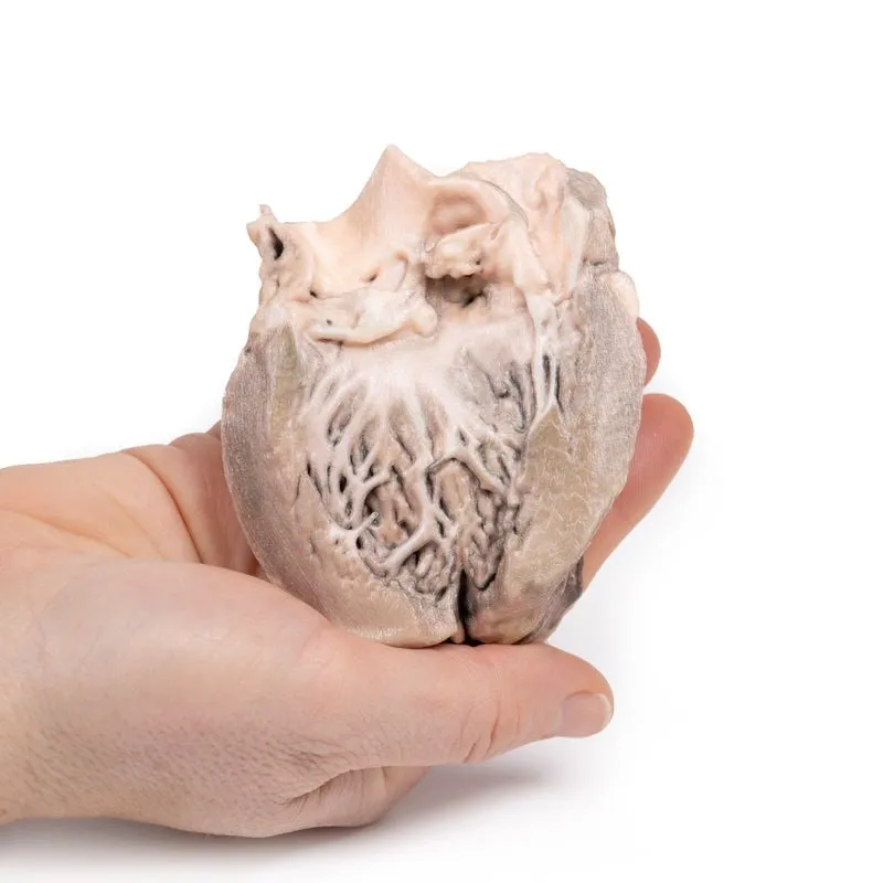 3D Printed Acute Bacterial Endocarditis