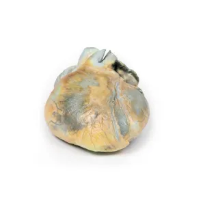 3D Printed Right Ventricular Hypertrophy