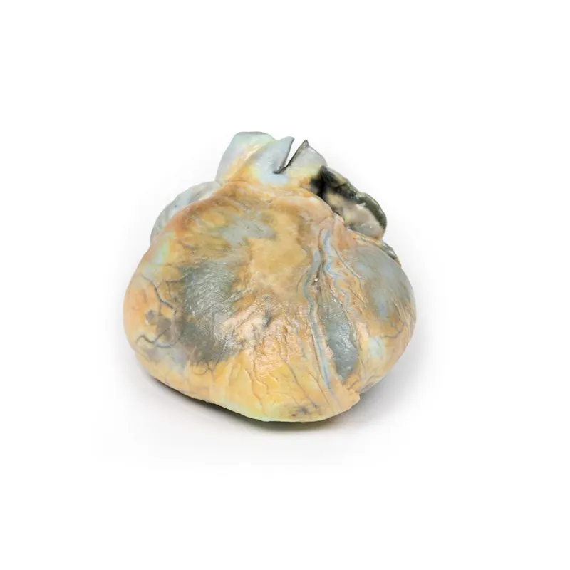 3D Printed Right Ventricular Hypertrophy