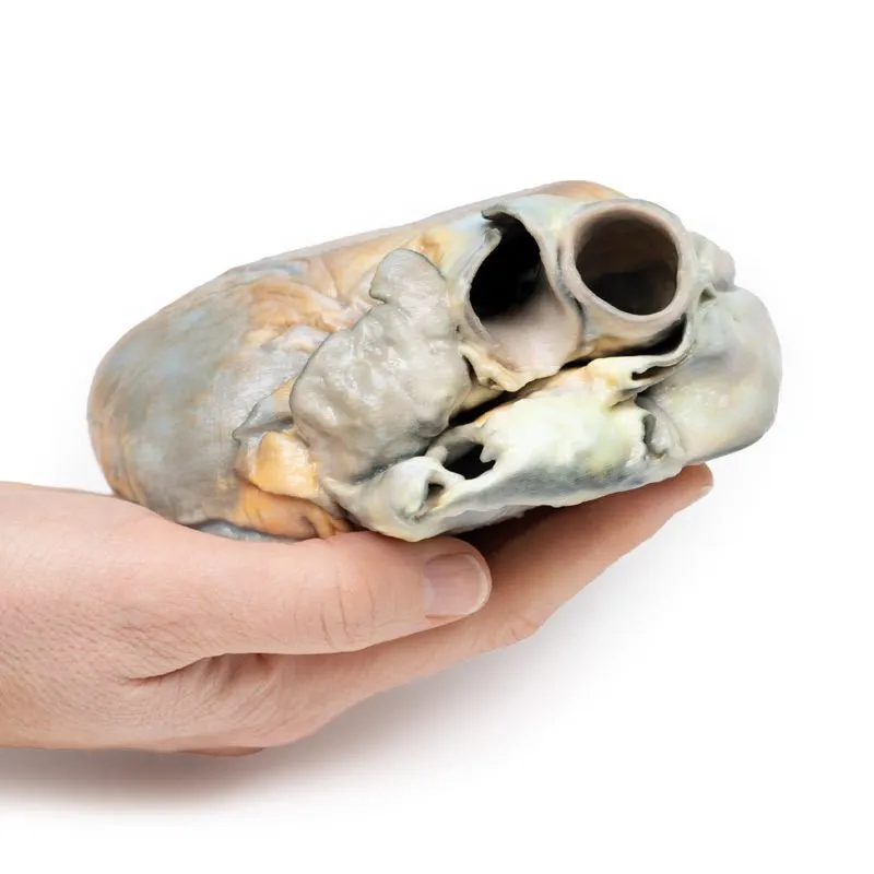 3D Printed Right Ventricular Hypertrophy