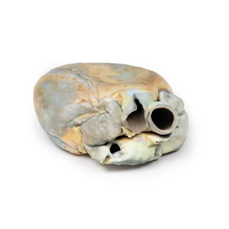 3D Printed Right Ventricular Hypertrophy