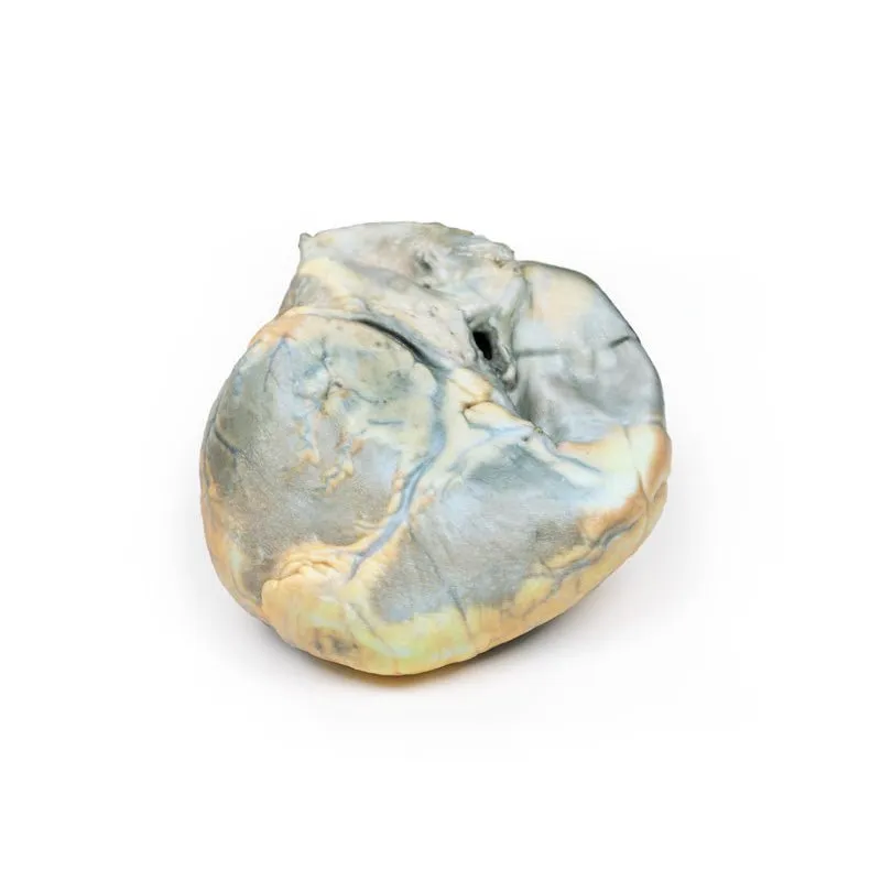 3D Printed Right Ventricular Hypertrophy